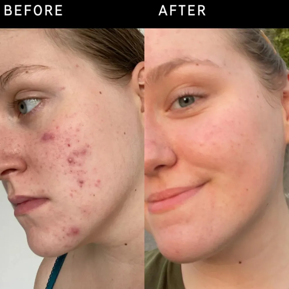 15% Vitamin C and EGF Serum