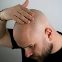 Bald Peeling