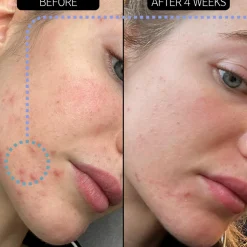 Blemish Clearing Moisturizer