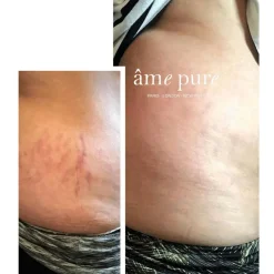 Body Basic - Stretch Marks