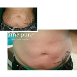 Body Basic - Stretch Marks