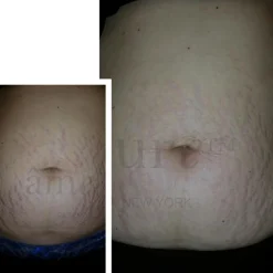 Body Basic - Stretch Marks