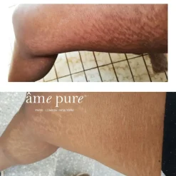 Body Basic - Stretch Marks