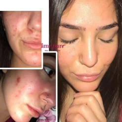 CIT Face Roller Platinum Kit