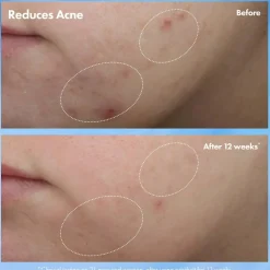 Clear Improvement Acne & Blackhead Clearing Hydrating Moisturizer Lotion
