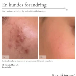 CP Chemical Peel 22%