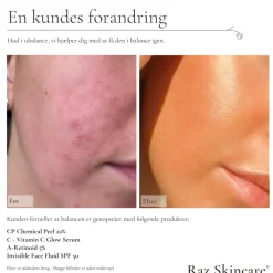 CP Chemical Peel 22%