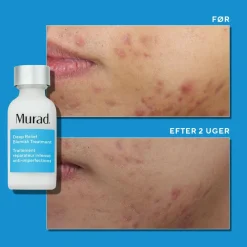 Deep Relief Blemish Treatment