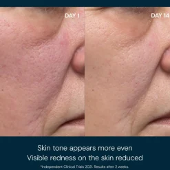 Dynamic Resurfacing Pads