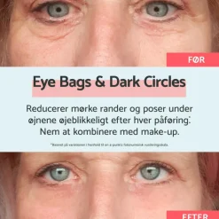 Eye bags & Dark Circles