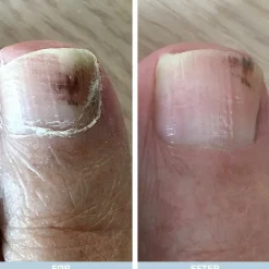 Fod og Neglepakke til Hård Hud