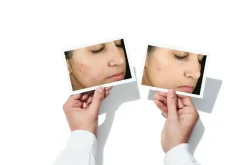 InvisiScar Resurfacing Treatment