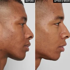 Mandelic Acid Treatment