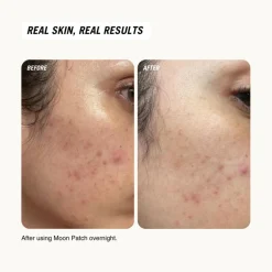 Moon Patch XL Centella Spot Care