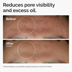 Niacinamide 10% + Zinc 1%