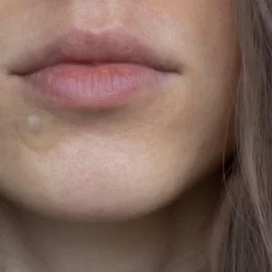 Pimple Patches Salicylsyre Bumseplastre