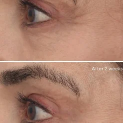 Retinal Resculpt Eye Treatment