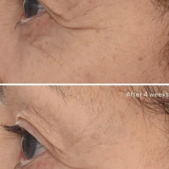 Retinal Resculpt Eye Treatment