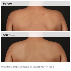 Salicylic Acid 0.5% Body Serum