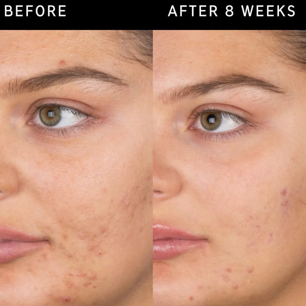 Salicylic Acid Cleanser