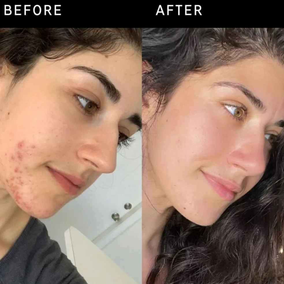 Succinic Acid Treatment