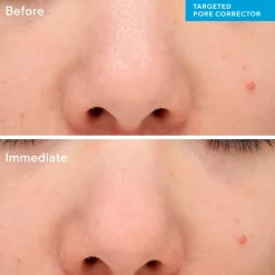 Targeted Pore Corrector