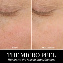 The Micro Peel