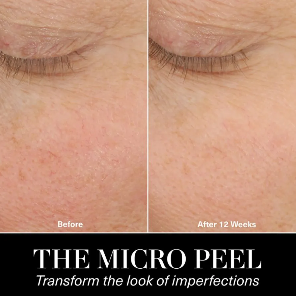 The Micro Peel