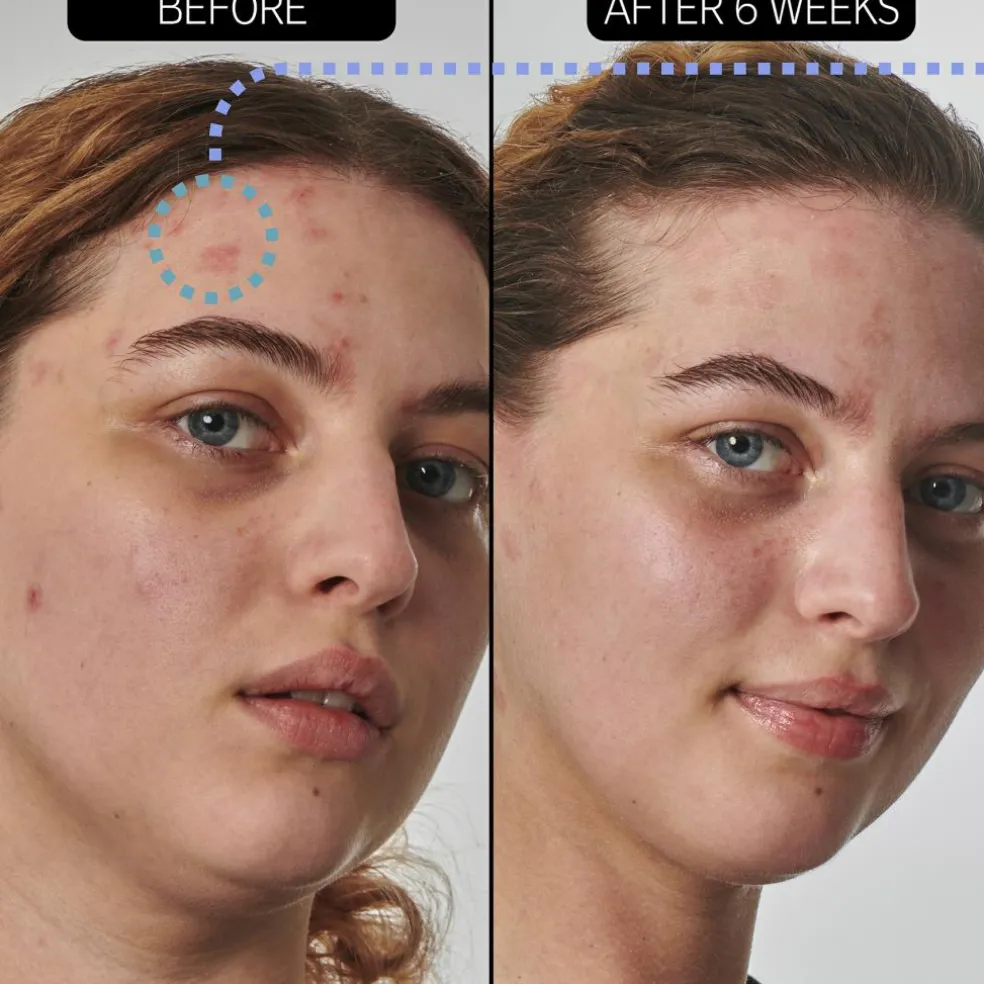 Urea 10% Moisturizer